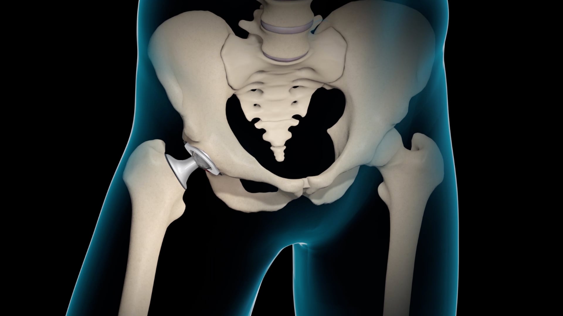 Hip skeleton