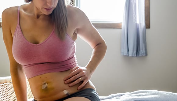 Woman after endometriosis surgery, sitting on a bed holding her side 